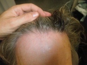 ecografia alopecia